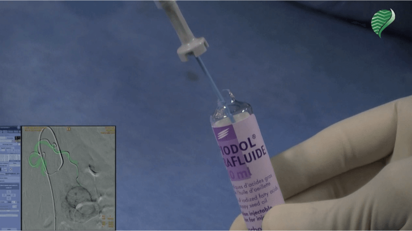 Selective trans arterial chemo embolization for liver metastasis from endocrine tumor