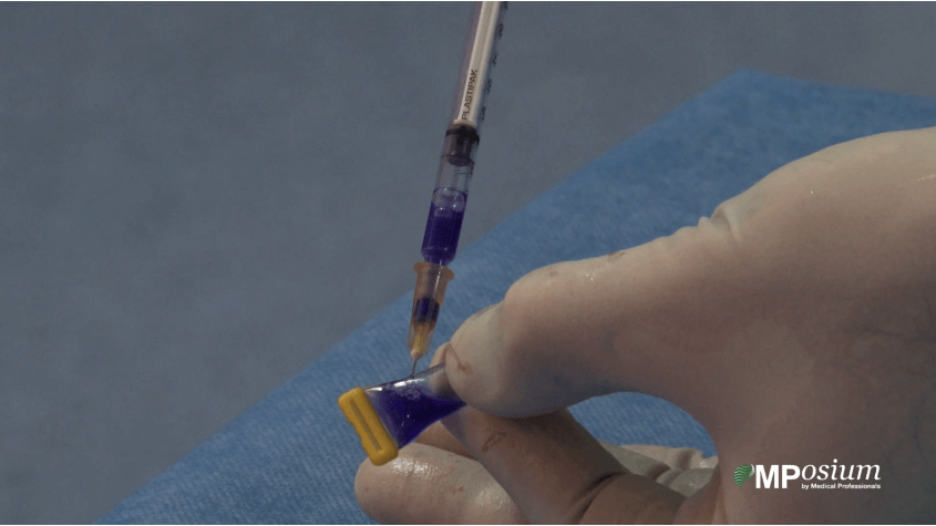Pre-operative right portal vein embolization
