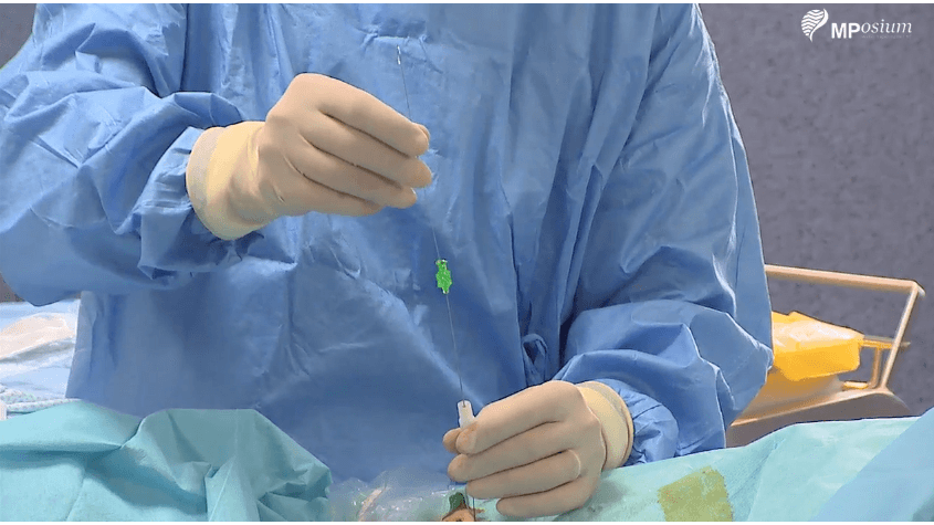 Us guided fiducial placement for stereotactic radiotherapy