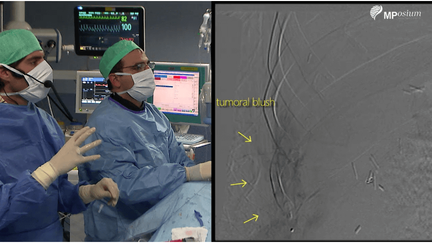 Tumor embolization
