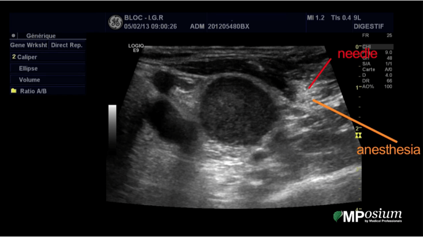Subclavicular node biopsy