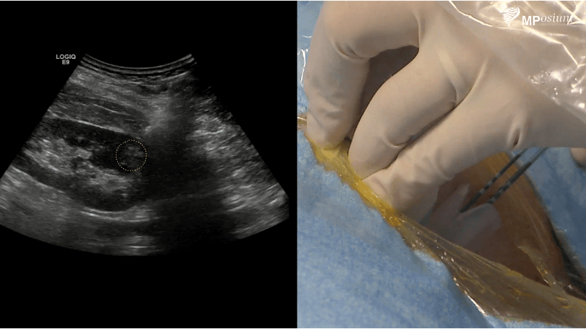 Renal Hemorragic angyomyolipoma radiofrequency ablation