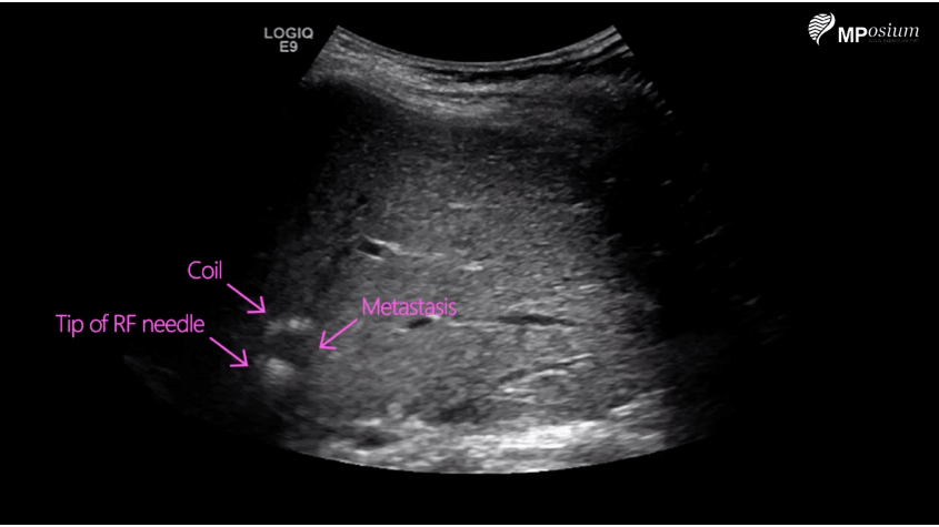 Radiofrequency ablation of a single liver metastasis