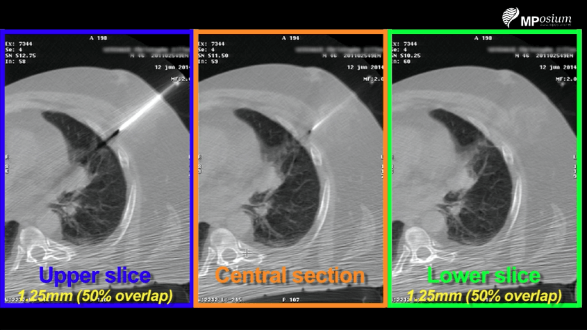 Lung biopsy