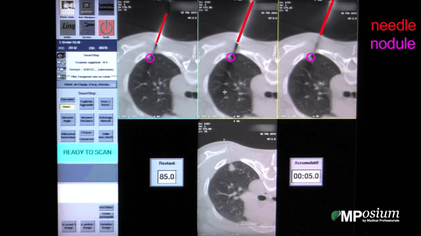 Lung biopsy