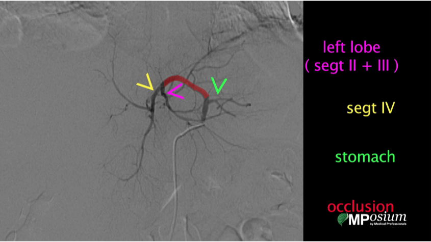 Percutaneous placement of hepatic intra-arterial catheter and ports