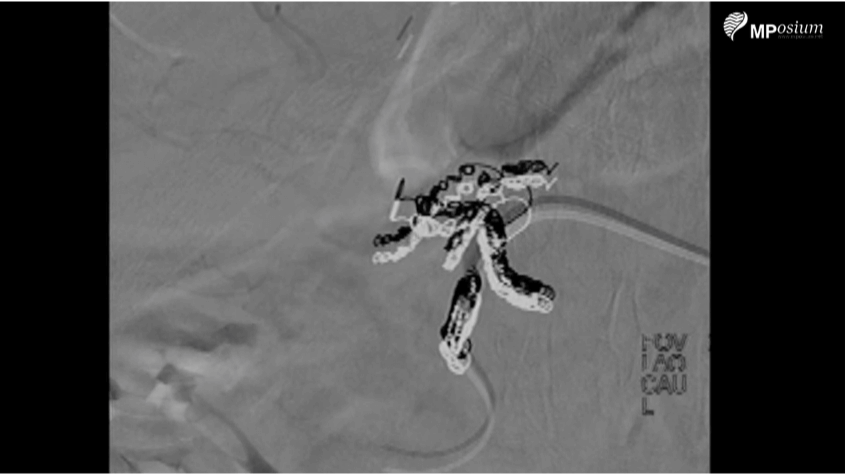 Implantation of an arterial port for hepatic intra-arterial chemotherapy