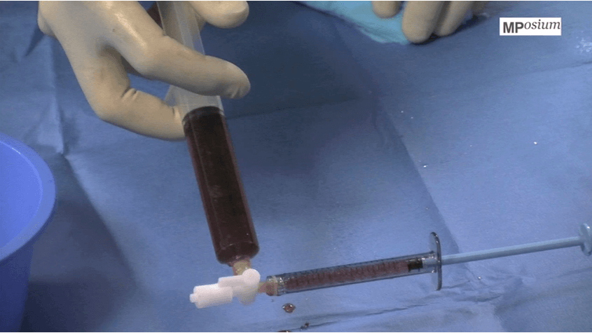 DEB-TACE for large hepatocellular carcinoma