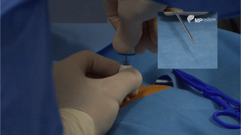 Bone biopsy