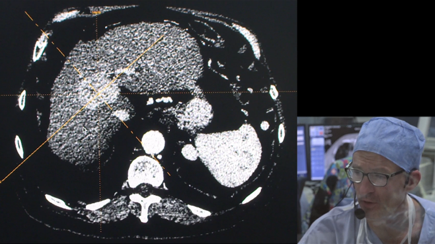TACE on single liver HCC with Lifepearl® Microspheres